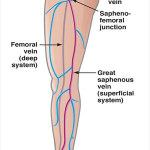 Phoenix Spider Veins - Sclerotherapy Vein Treatment - Explained
