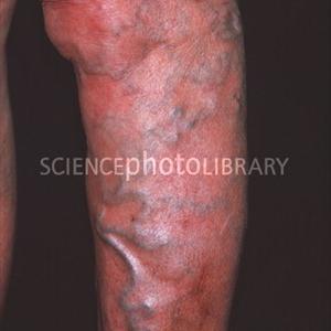 Varicose Eczema Cellulitis - If Left Untreated, Varicose Veins Can Pose Risks