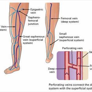 Spidervein Removal - Discussion Of Varicose Veins And FAQ