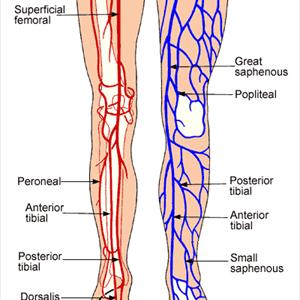 Vericose Vein Doctor - Is Sclerotherapy Worth It?