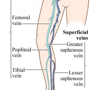 Anti Varicose Veins - Varicose Veins More That A Cosmetic Concern