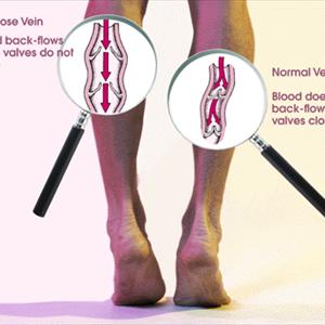 Varicose Eczema - Information On Klippel Trenaunay Syndrome