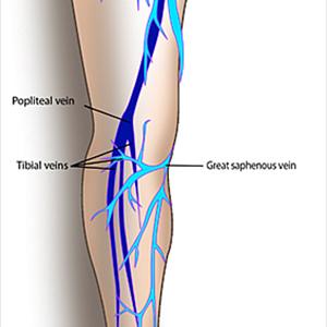 Prevention Varicose Veins - Varicose Veins Treatment, Get Rid Of Varicose Veins