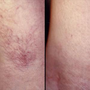 Varicose Vein Picture - If Left Untreated, Varicose Veins Can Pose Risks