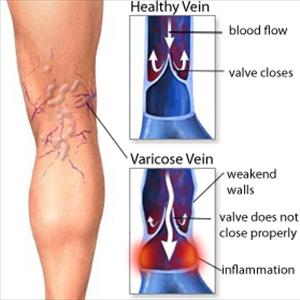 Varicose Veins Itching - Varicose Veins - Vitamins For Varicose Veins
