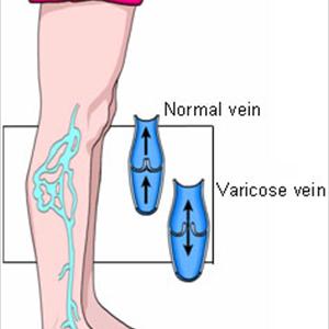 Herb Varicose Vein - Alternative Treatment For Varicose Veins