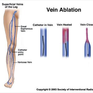 Eliminating Varicose Veins - What You Need To Know About The Different Types Of Varicose Veins Surgeries