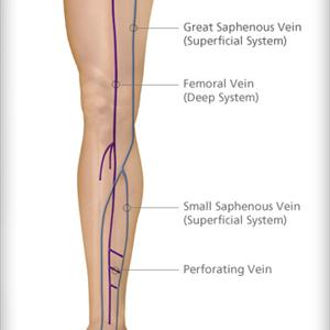 Healing Varicose Veins - Sclerotherapy Vein Treatment - Explained